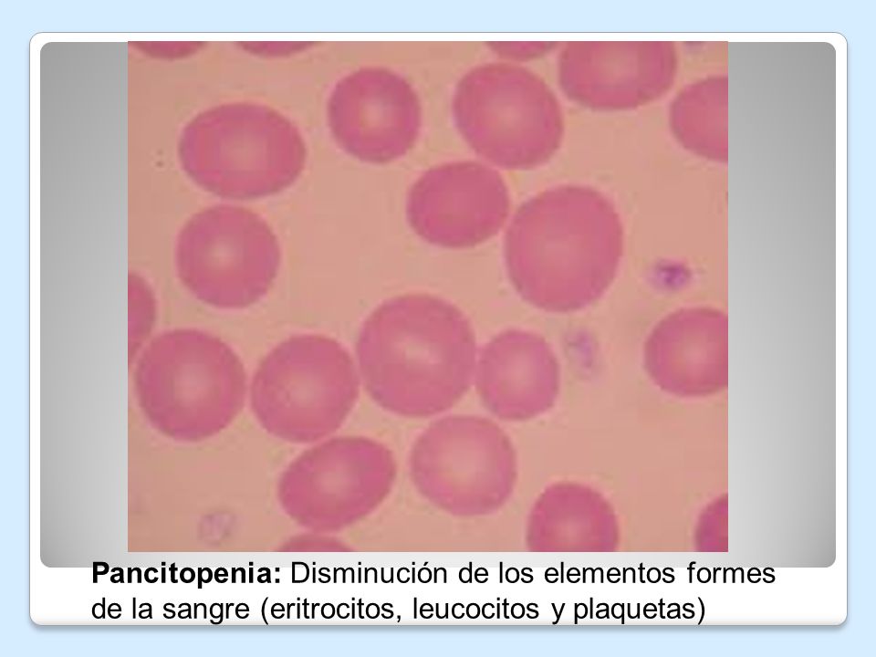 Pancitopenia: Disminución de los elementos formes de la sangre (eritrocitos, leucocitos y plaquetas)