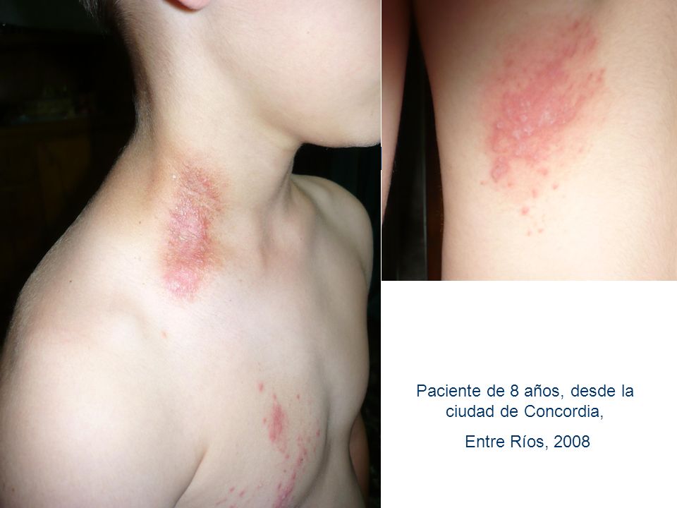 Paciente de 8 años, desde la ciudad de Concordia,
