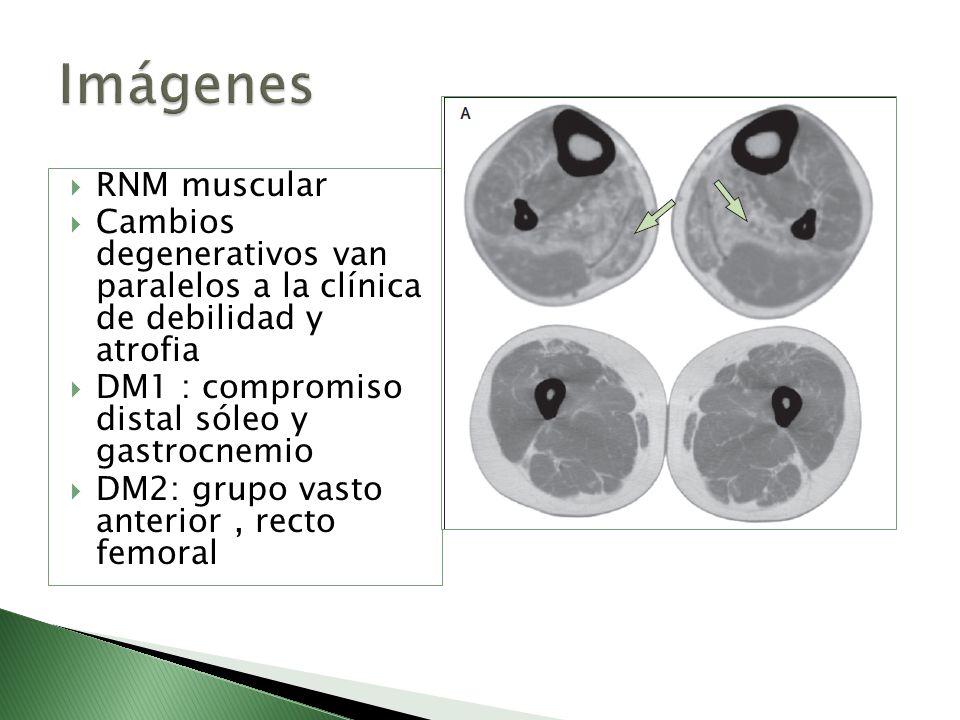 Imágenes RNM muscular. Cambios degenerativos van paralelos a la clínica de debilidad y atrofia.