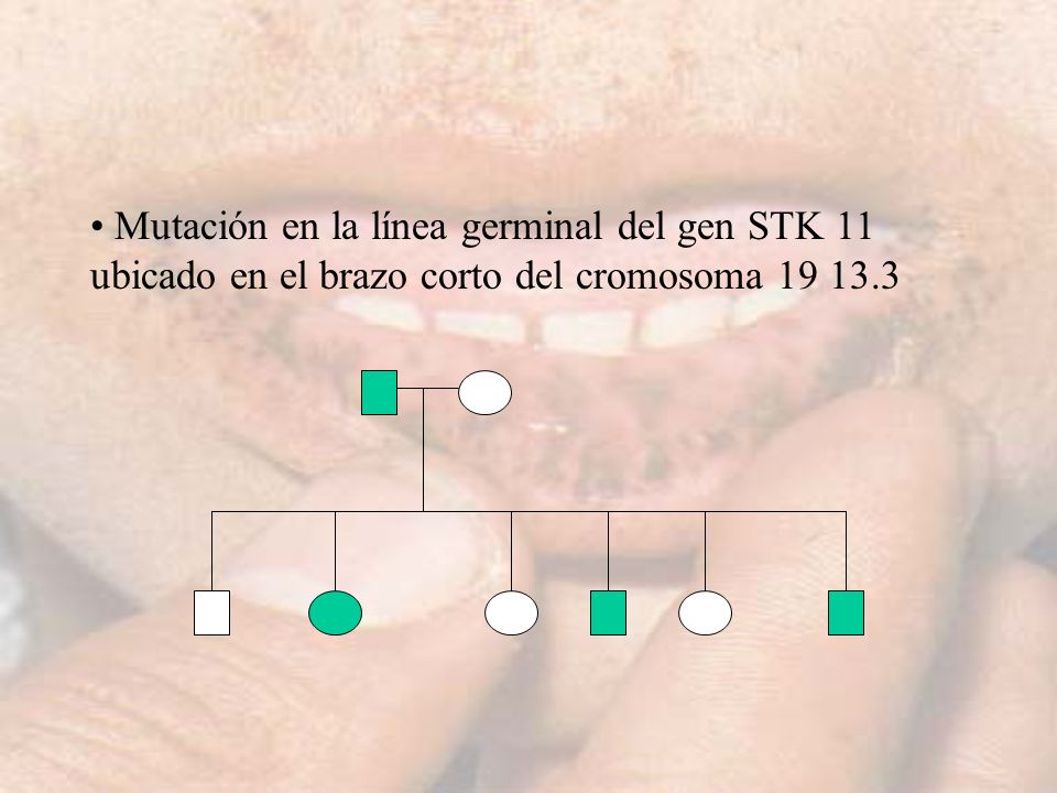 Mutación en la línea germinal del gen STK 11 ubicado en el brazo corto del cromosoma