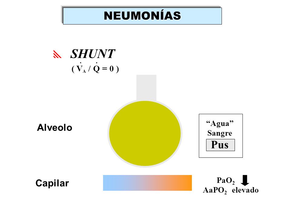 NEUMONÍAS SHUNT . Pus Alveolo Capilar ( VA / Q = 0 ) Agua Sangre