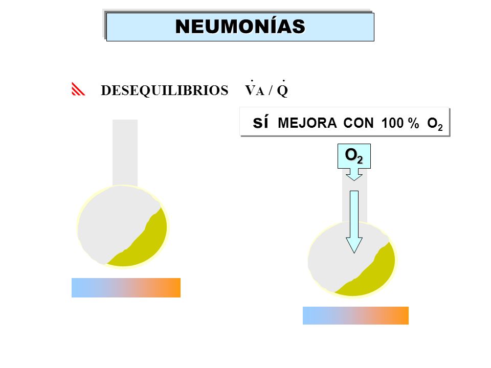 NEUMONÍAS . . DESEQUILIBRIOS VA / Q sí MEJORA CON 100 % O2 O2