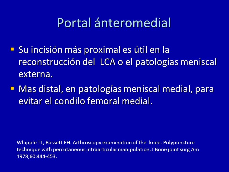 Portal ánteromedial Su incisión más proximal es útil en la reconstrucción del LCA o el patologías meniscal externa.