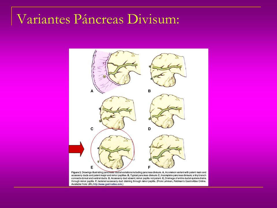 Variantes Páncreas Divisum:
