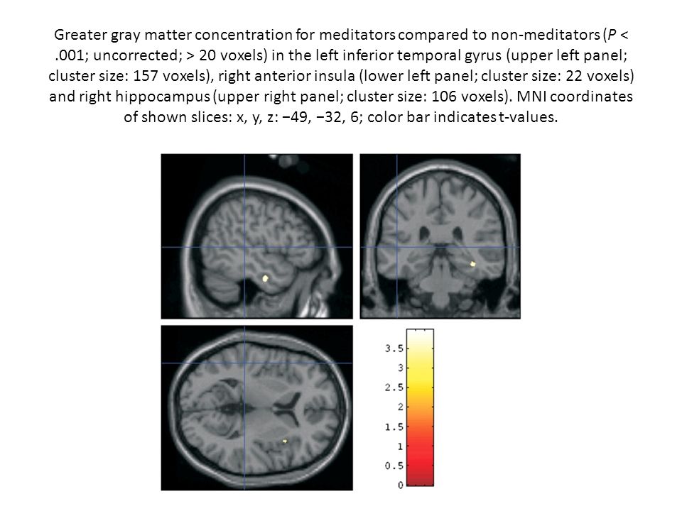 Greater gray matter concentration for meditators compared to non-meditators (P < .001; uncorrected; > 20 voxels) in the left inferior temporal gyrus (upper left panel; cluster size: 157 voxels), right anterior insula (lower left panel; cluster size: 22 voxels) and right hippocampus (upper right panel; cluster size: 106 voxels).