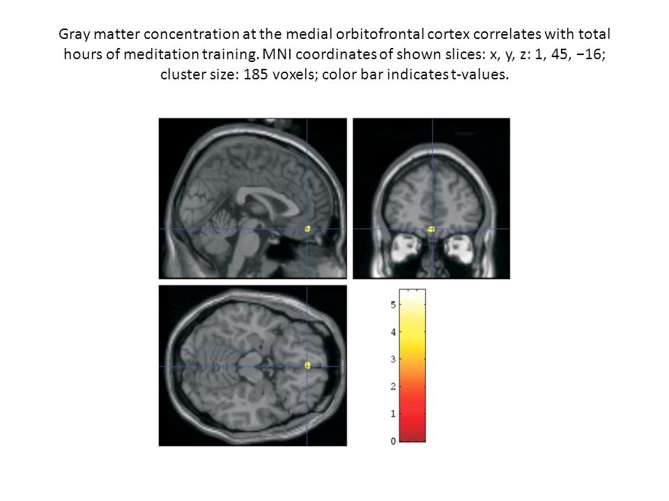 Gray matter concentration at the medial orbitofrontal cortex correlates with total hours of meditation training.