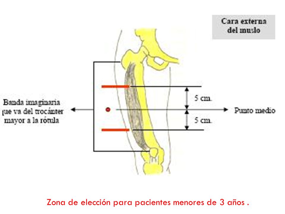 Zona de elección para pacientes menores de 3 años .