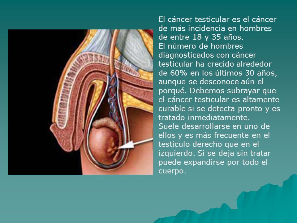 El cáncer testicular es el cáncer de más incidencia en hombres de entre 18 y 35 años.