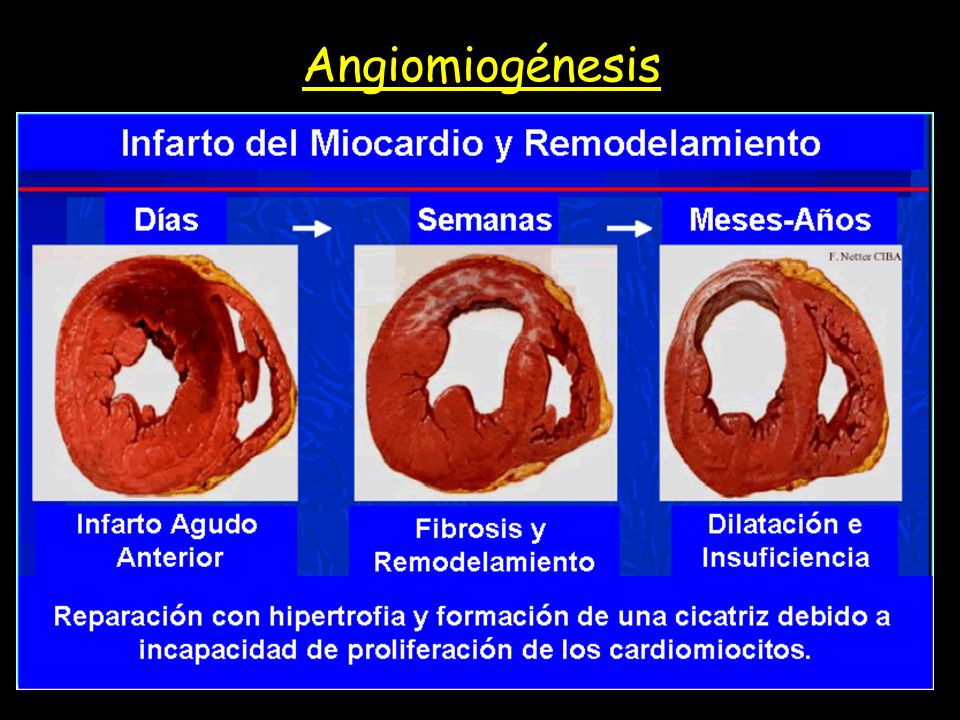 Angiomiogénesis