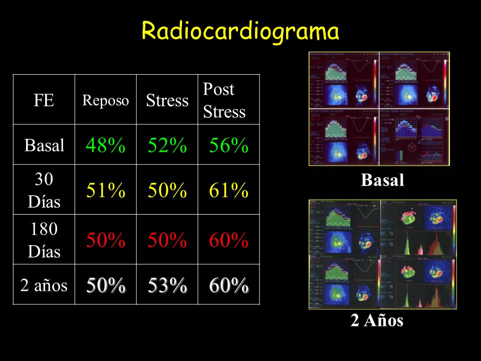 Radiocardiograma 48% 52% 56% 51% 50% 61% 60% 53% FE Stress Post Stress