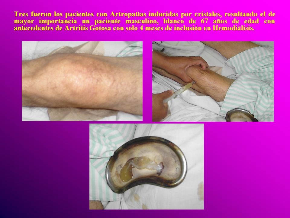 Tres fueron los pacientes con Artropatías inducidas por cristales, resultando el de mayor importancia un paciente masculino, blanco de 67 años de edad con antecedentes de Artritis Gotosa con solo 4 meses de inclusión en Hemodiálisis.
