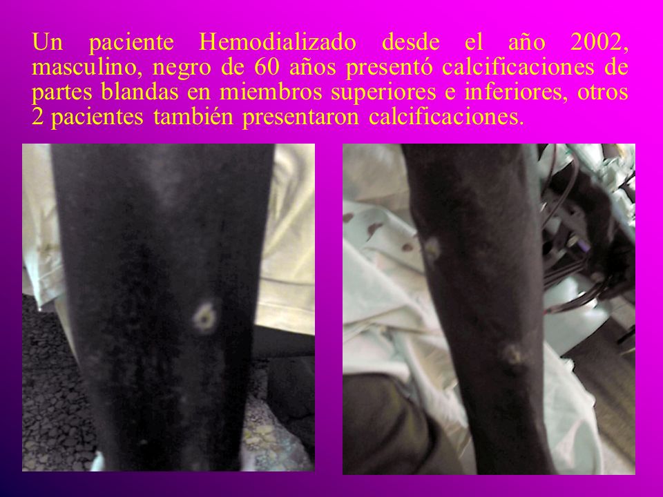 Un paciente Hemodializado desde el año 2002, masculino, negro de 60 años presentó calcificaciones de partes blandas en miembros superiores e inferiores, otros 2 pacientes también presentaron calcificaciones.