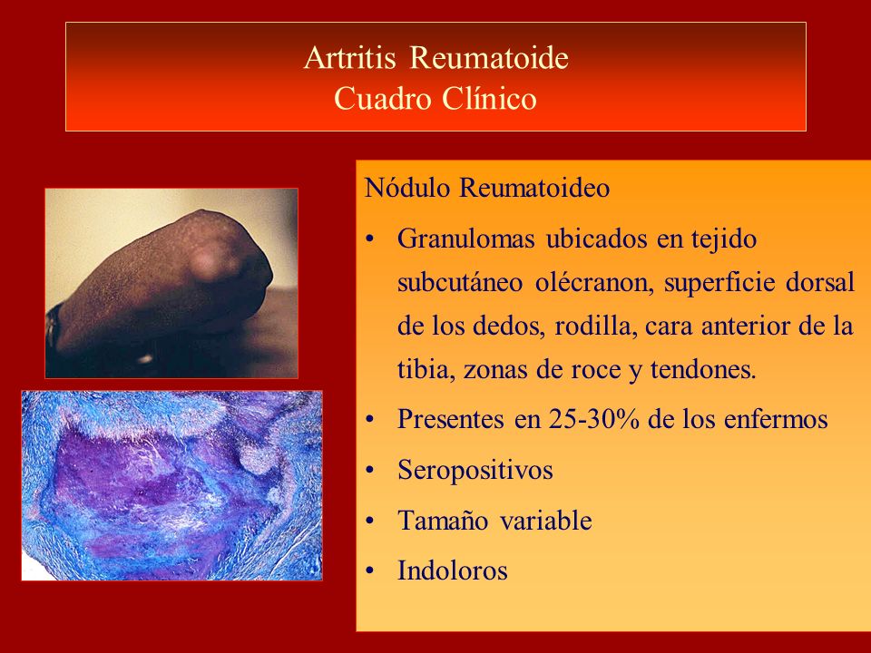 artritis reumatoide cuadro clinico diagn 243 stico diferencial de artritis curso de cl 237 nica artritis reumatoide cuadro clinico diagn 243 stico diferencial de artritis curso de cl 237 nica
