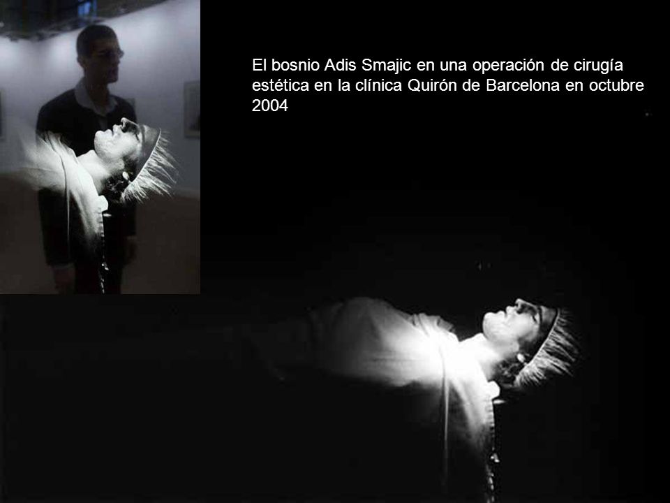 El bosnio Adis Smajic en una operación de cirugía estética en la clínica Quirón de Barcelona en octubre 2004