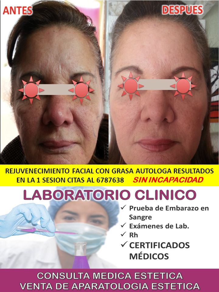 REJUVENECIMIENTO FACIAL CON GRASA AUTOLOGA RESULTADOS EN LA 1 SESION CITAS AL SIN INCAPACIDAD