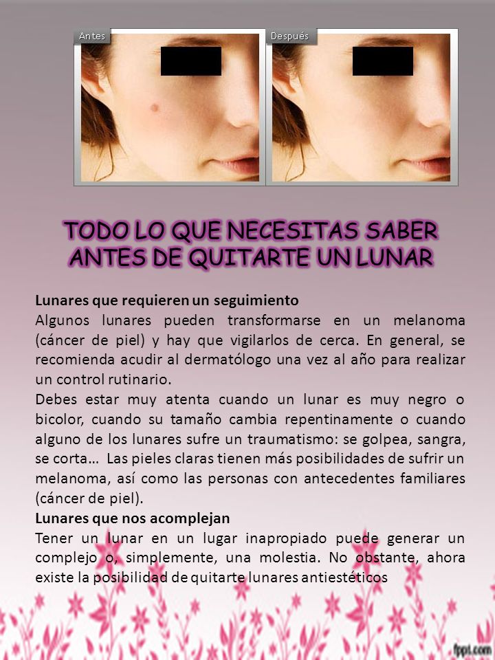 TODO LO QUE NECESITAS SABER ANTES DE QUITARTE UN LUNAR