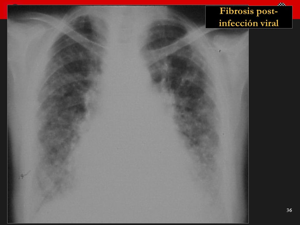 Fibrosis post-infección viral
