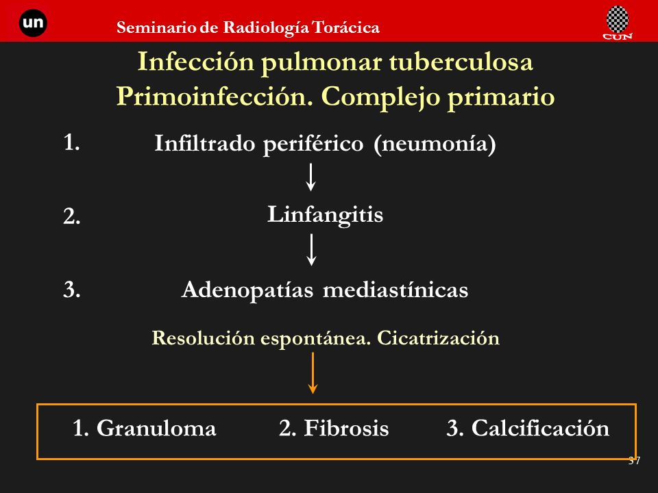 Infección pulmonar tuberculosa Primoinfección. Complejo primario