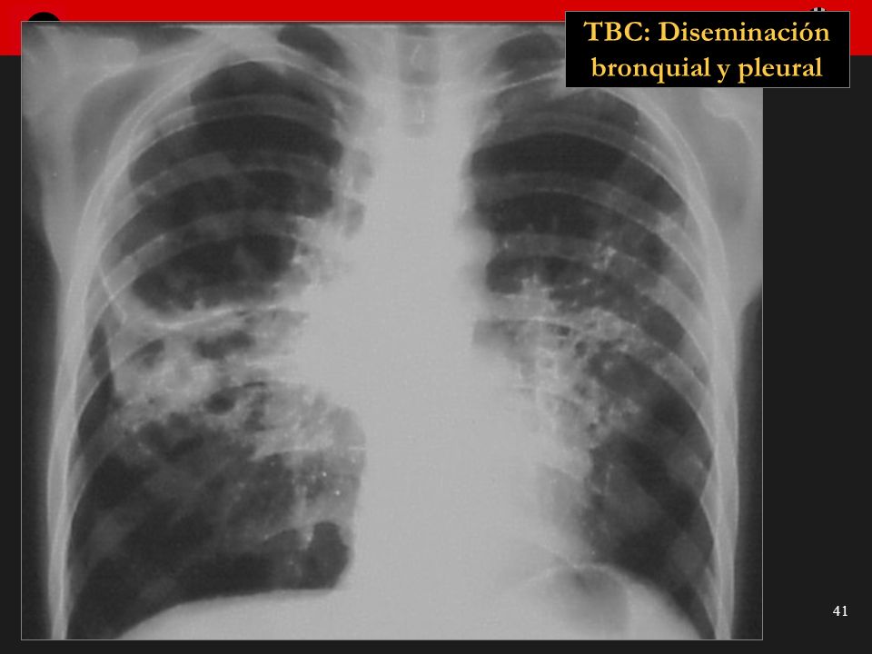 TBC: Diseminación bronquial y pleural