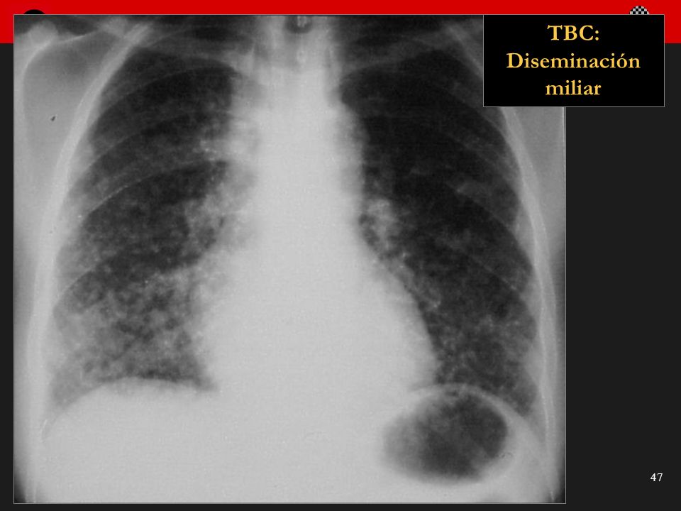 TBC: Diseminación miliar