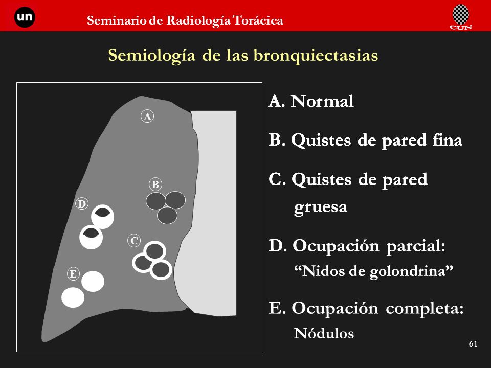 Semiología de las bronquiectasias