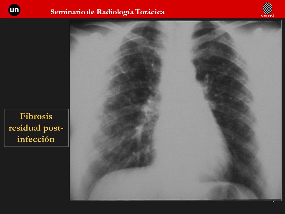 Fibrosis residual post-infección