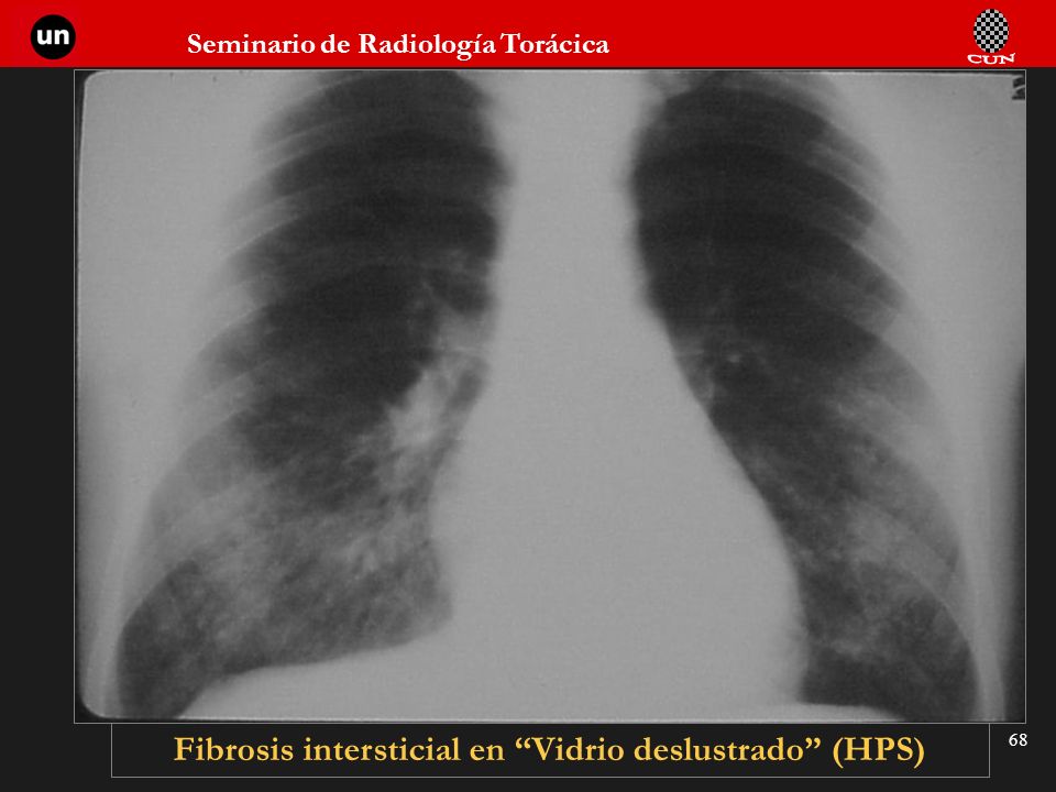 Fibrosis intersticial en Vidrio deslustrado (HPS)