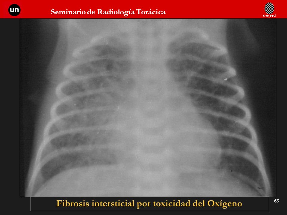 Fibrosis intersticial por toxicidad del Oxígeno