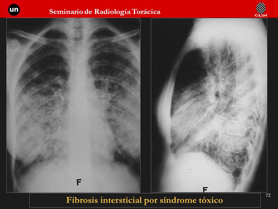 Fibrosis intersticial por síndrome tóxico