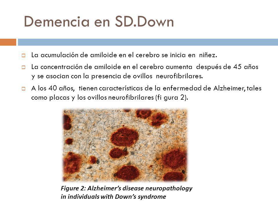Demencia en SD.Down La acumulación de amiloide en el cerebro se inicia en niñez.