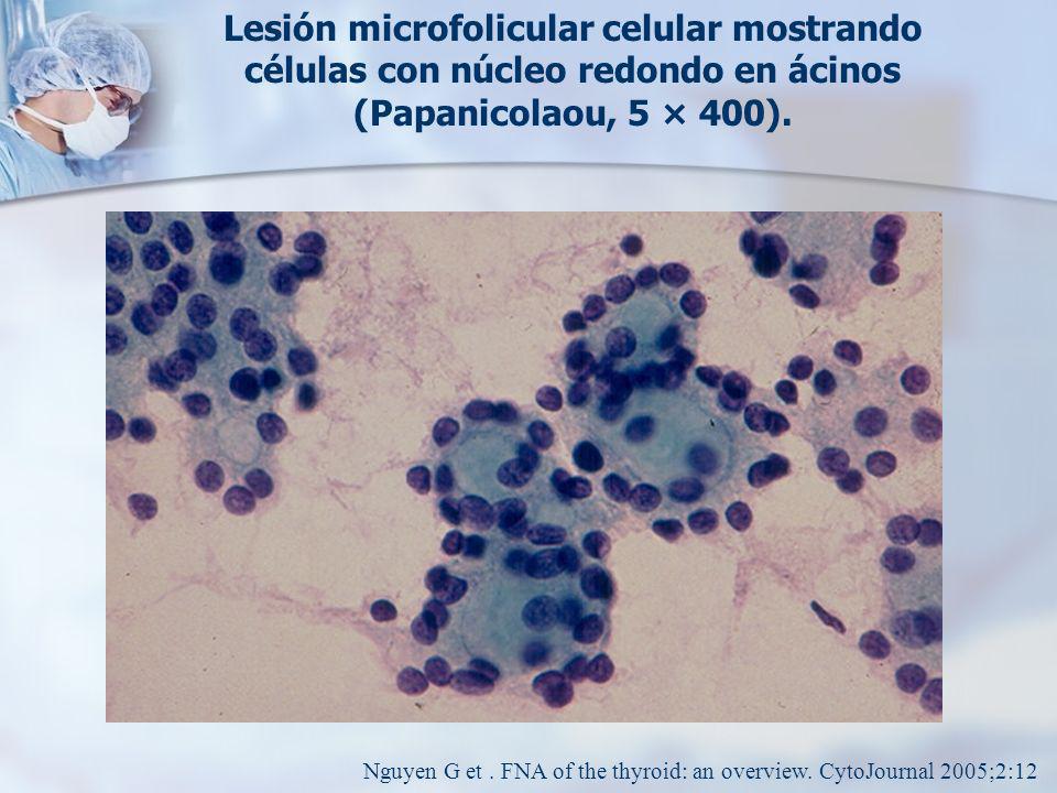 Lesión microfolicular celular mostrando células con núcleo redondo en ácinos (Papanicolaou, 5 × 400).