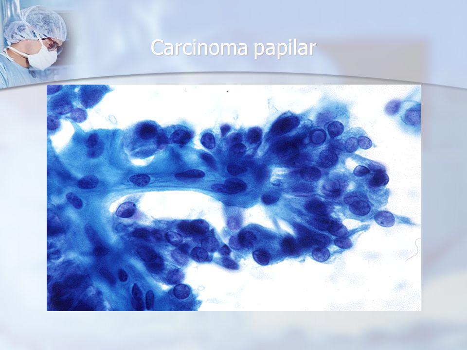 Carcinoma papilar Fine needle aspiration cytology specimens. (C) Epithelial cells in a papillary.
