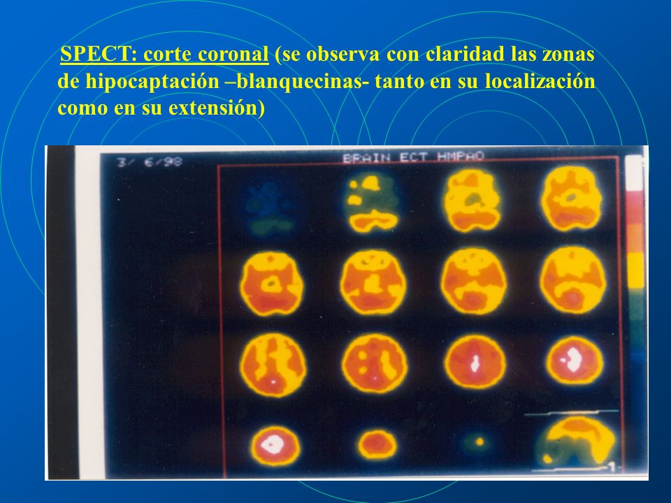 SPECT: corte coronal (se observa con claridad las zonas de hipocaptación –blanquecinas- tanto en su localización como en su extensión)