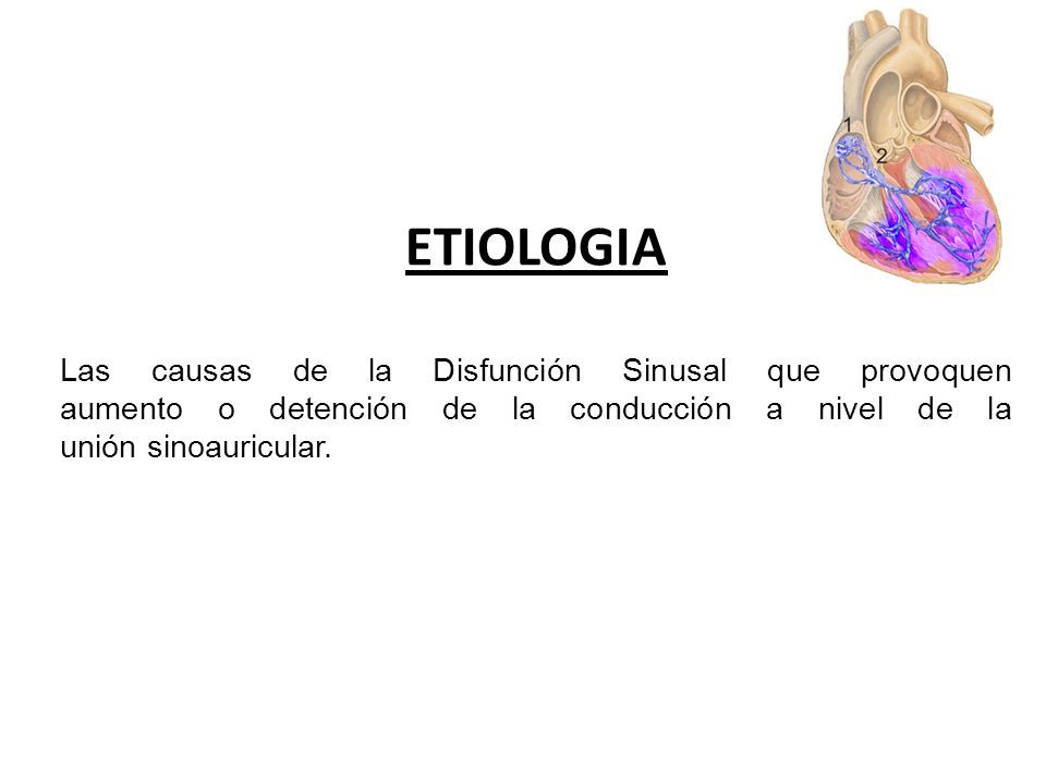 ETIOLOGIA Las causas de la Disfunción Sinusal que provoquen aumento o detención de la conducción a nivel de la unión sinoauricular.