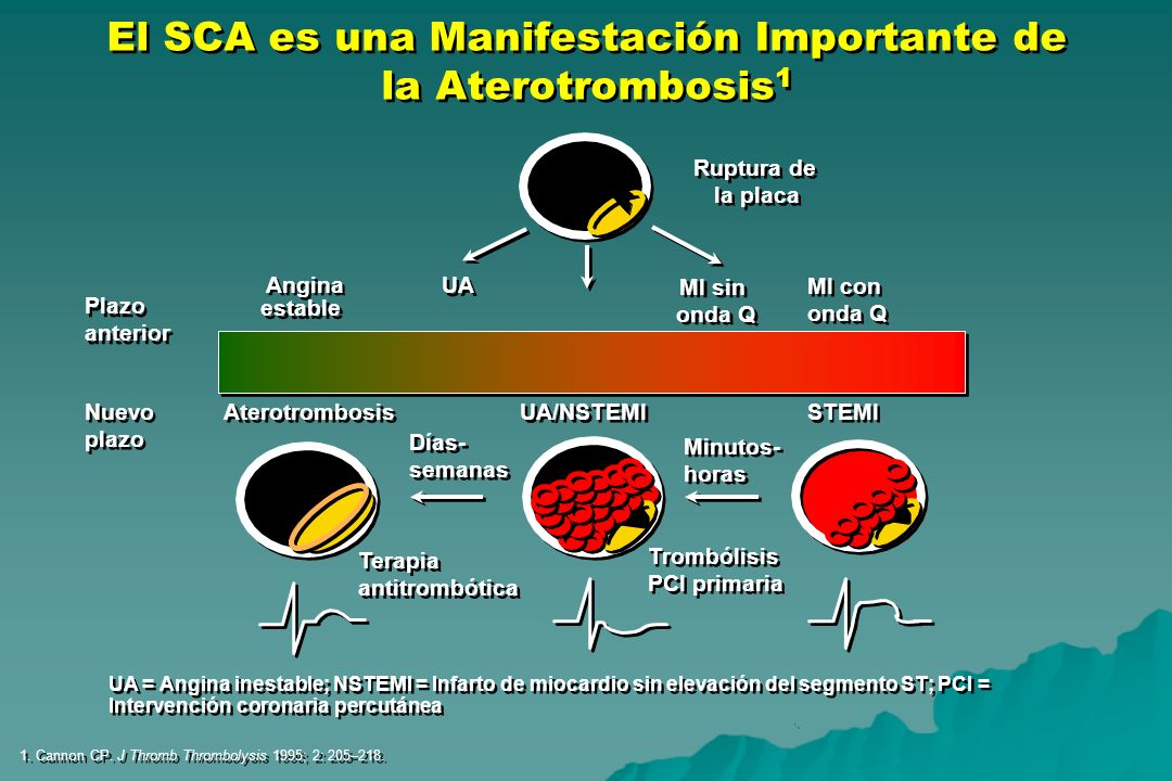 El SCA es una Manifestación Importante de la Aterotrombosis1