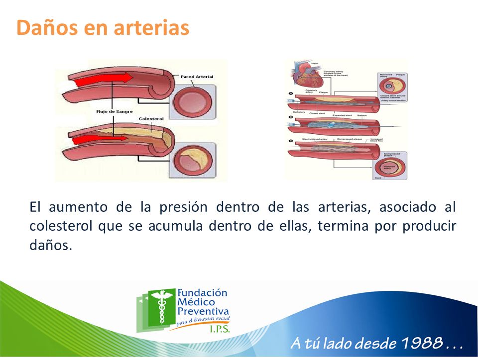 Daños en arterias El aumento de la presión dentro de las arterias, asociado al colesterol que se acumula dentro de ellas, termina por producir daños.