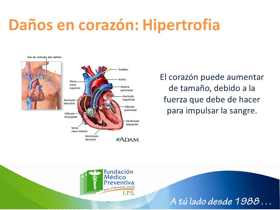Daños en corazón: Hipertrofia