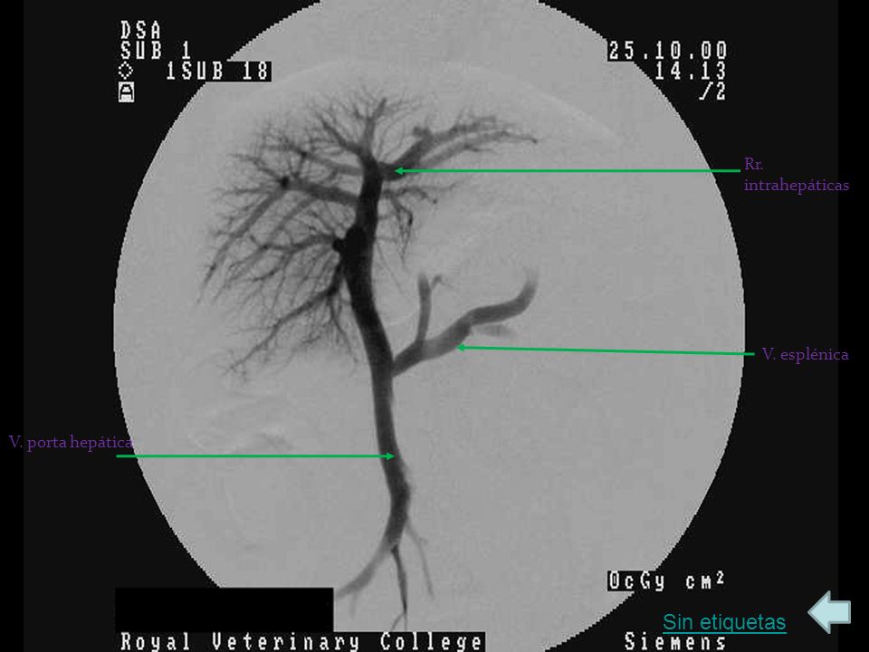 Rr. intrahepáticas V. esplénica V. porta hepática Sin etiquetas