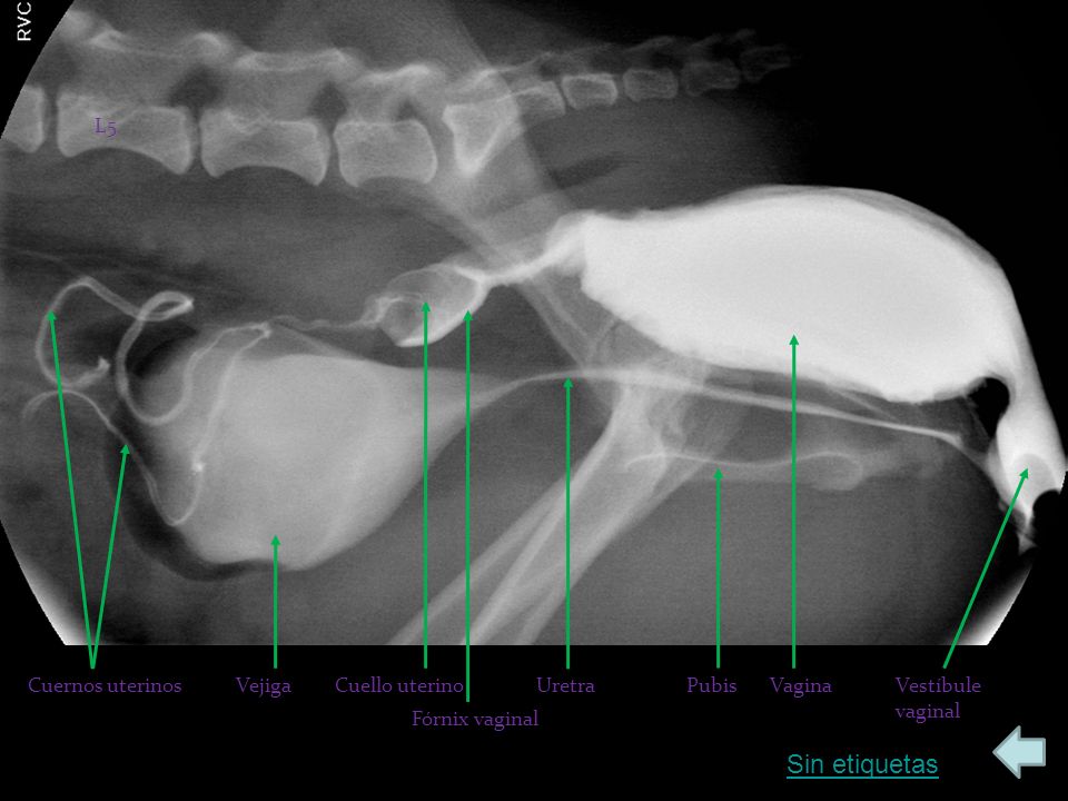 Sin etiquetas L5 Cuernos uterinos Vejiga Cuello uterino Uretra Pubis