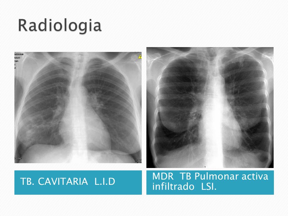 Radiologia TB. CAVITARIA L.I.D MDR TB Pulmonar activa infiltrado LSI.