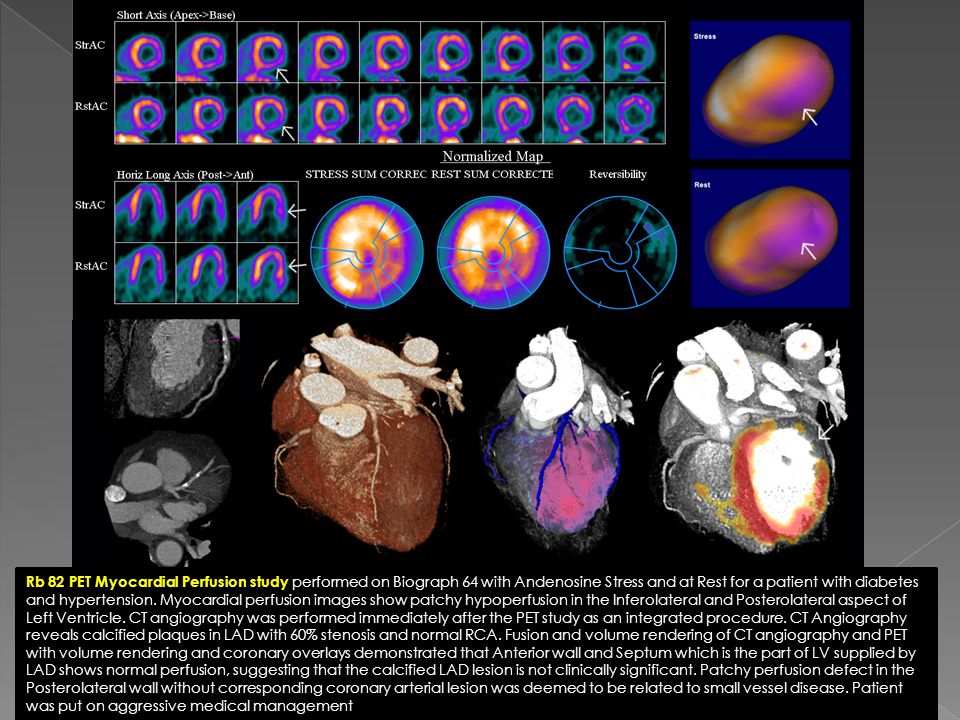 Rb 82 PET Myocardial Perfusion study performed on Biograph 64 with Andenosine Stress and at Rest for a patient with diabetes and hypertension.