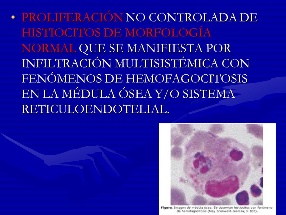 PROLIFERACIÓN NO CONTROLADA DE HISTIOCITOS DE MORFOLOGÍA NORMAL QUE SE MANIFIESTA POR INFILTRACIÓN MULTISISTÉMICA CON FENÓMENOS DE HEMOFAGOCITOSIS EN LA MÉDULA ÓSEA Y/O SISTEMA RETICULOENDOTELIAL.