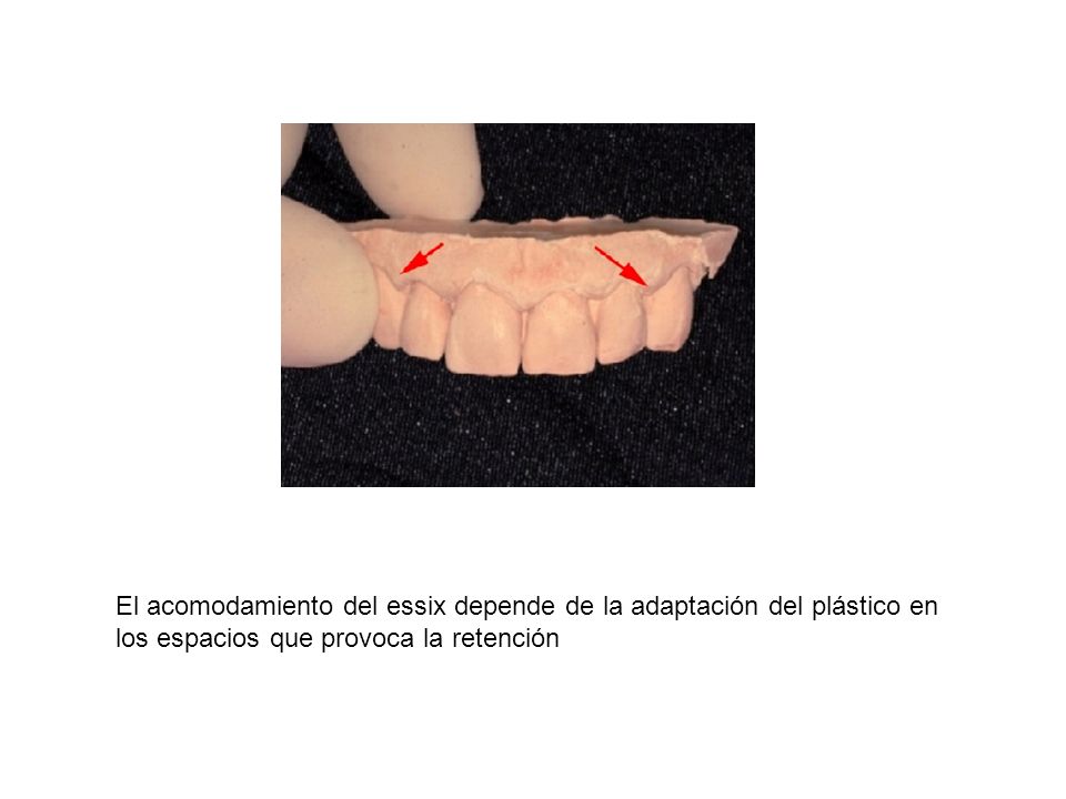 El acomodamiento del essix depende de la adaptación del plástico en los espacios que provoca la retención