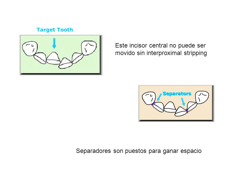 Este incisor central no puede ser movido sin interproximal stripping