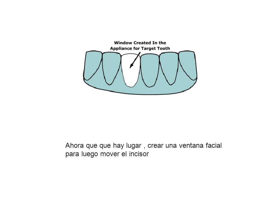 Ahora que que hay lugar , crear una ventana facial para luego mover el incisor