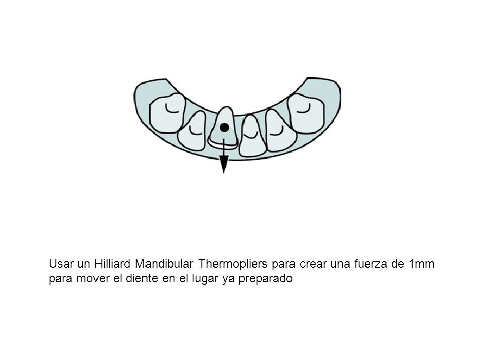 Usar un Hilliard Mandibular Thermopliers para crear una fuerza de 1mm para mover el diente en el lugar ya preparado