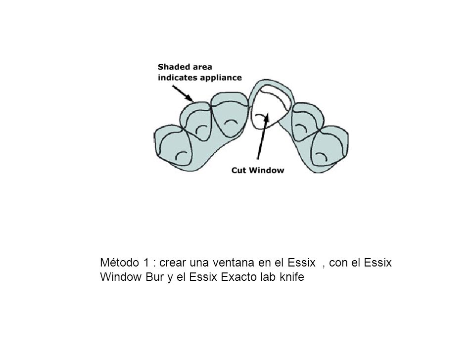 Método 1 : crear una ventana en el Essix , con el Essix Window Bur y el Essix Exacto lab knife