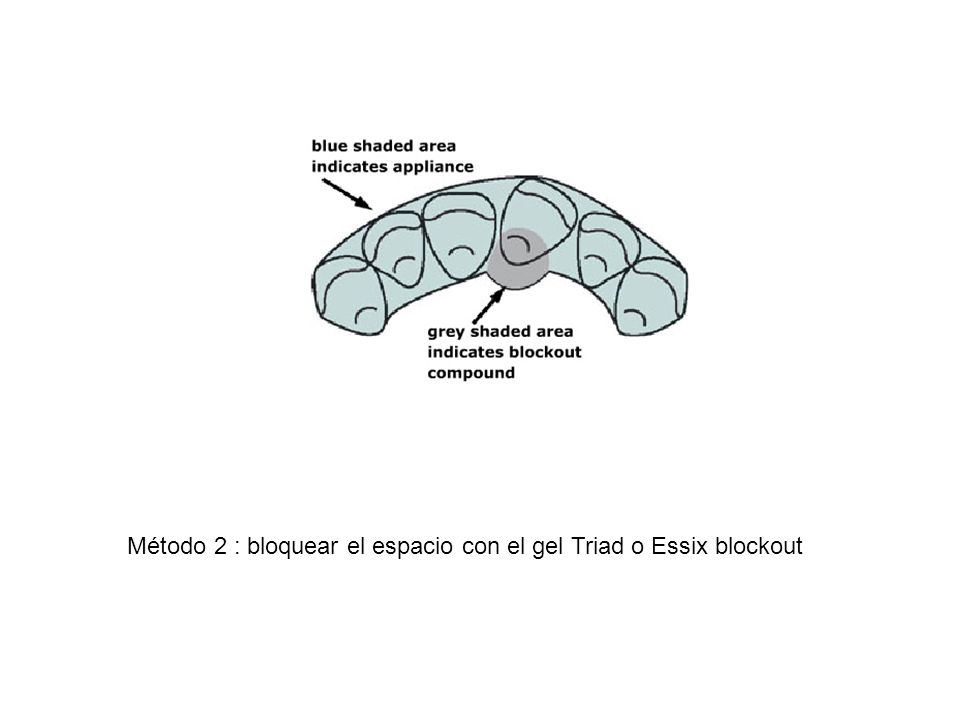 Método 2 : bloquear el espacio con el gel Triad o Essix blockout
