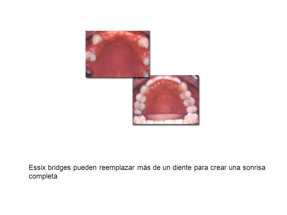 Essix bridges pueden reemplazar más de un diente para crear una sonrisa completa