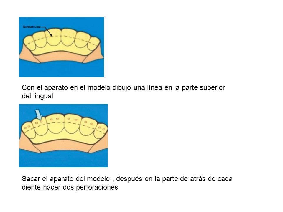 Con el aparato en el modelo dibujo una línea en la parte superior del lingual